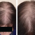 The Truth About Hair Loss: Is There a Difference Between Male and Female Pattern Baldness?