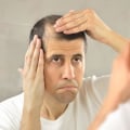 The Impact of Hair Loss on Self-Esteem