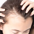 Understanding the Causes of Hair Loss