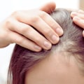 Hair Loss: Understanding the Connection with Medical Treatments