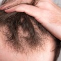 Understanding the Signs of Hair Loss