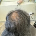 Preventing Hair Loss: Expert Tips and Advice