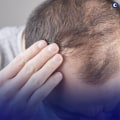 The Truth About Hair Loss: Understanding the Medical Conditions Behind It