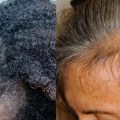 Understanding Stress-Related Alopecia and Its Reversal