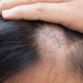 The Truth About Hair Loss: Can It Be Reversed?