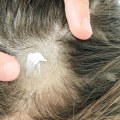 The Connection Between Scalp Infections and Hair Loss