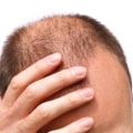 The Truth About Hair Loss: Is it More Common in Men or Women?