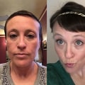The Truth About Hair Loss and Chemotherapy