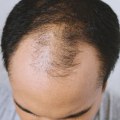 The Truth About Hair Loss and Medications