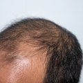 The Role of Genetics in Hair Loss
