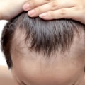 Natural Remedies for Hair Loss: Expert Insights