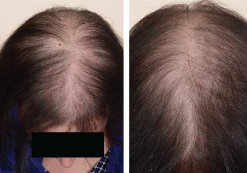 The Truth About Hair Loss: Is There a Difference Between Male and Female Pattern Baldness?