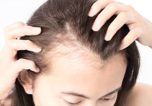 Understanding the Causes of Hair Loss