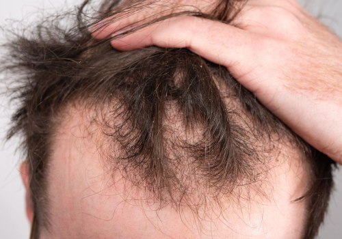 Understanding the Signs of Hair Loss