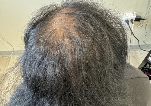 Preventing Hair Loss: Expert Tips and Advice
