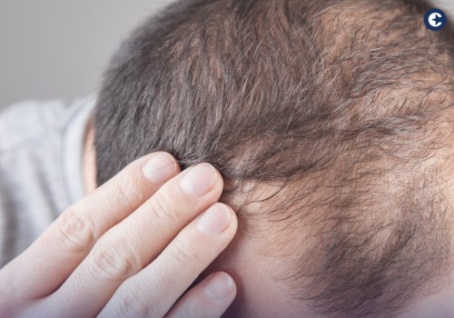 The Truth About Hair Loss: Understanding the Medical Conditions Behind It
