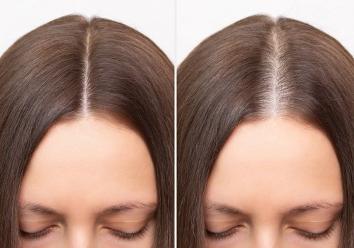 The Impact of Age on Hair Loss