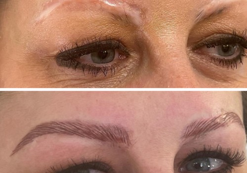Alopecia & Eyebrow Loss: Cosmetic Options for Restoring Natural-Looking Brows