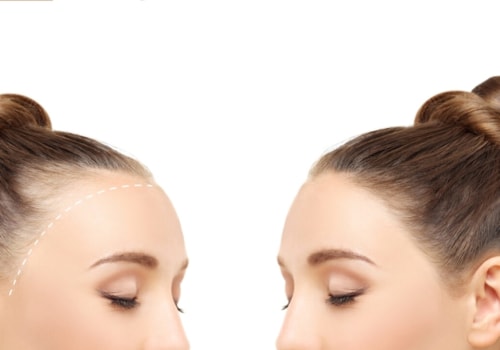 The Role of Hormones in Female Hair Loss