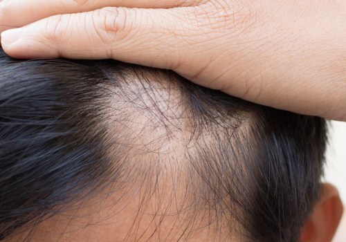 The Truth About Hair Loss: Can It Be Reversed?