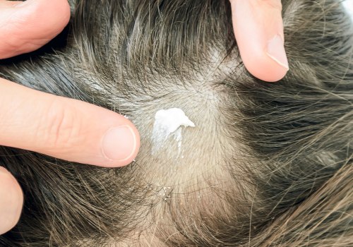 The Connection Between Scalp Infections and Hair Loss