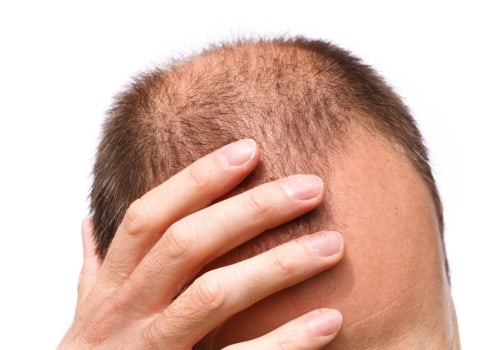 The Truth About Hair Loss: Is it More Common in Men or Women?