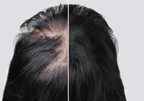 Understanding the Different Types of Hair Loss