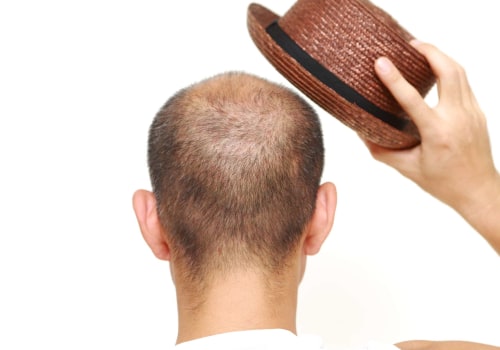 The Truth About Hats and Hair Loss: Debunking the Myth