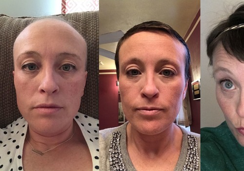 The Truth About Hair Loss and Chemotherapy