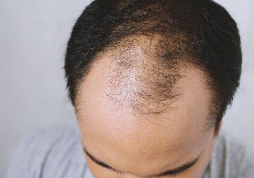 The Truth About Hair Loss and Medications