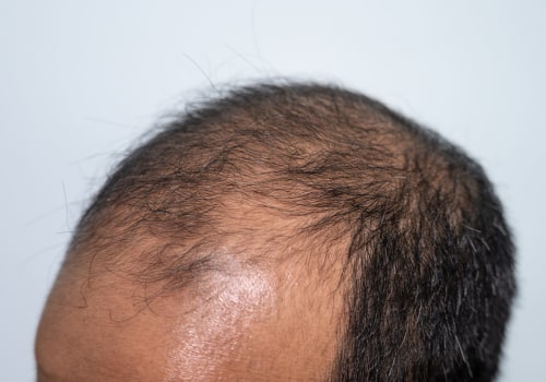 The Role of Genetics in Hair Loss