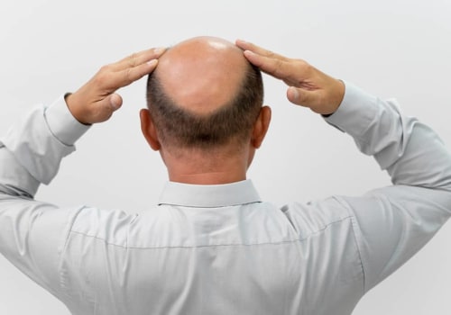 Hair Loss: A Sign of a Serious Health Condition?