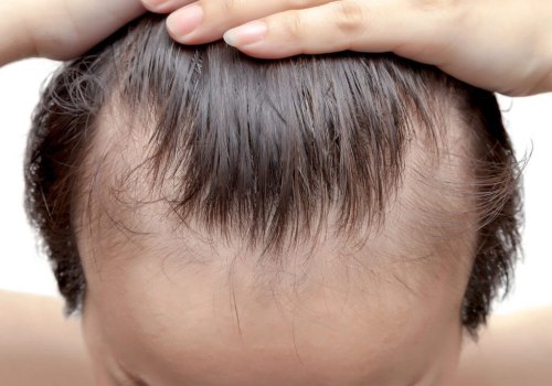 Natural Remedies for Hair Loss: Expert Insights