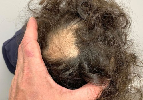 The Truth About Hair Loss: Can Stress Really Cause It?